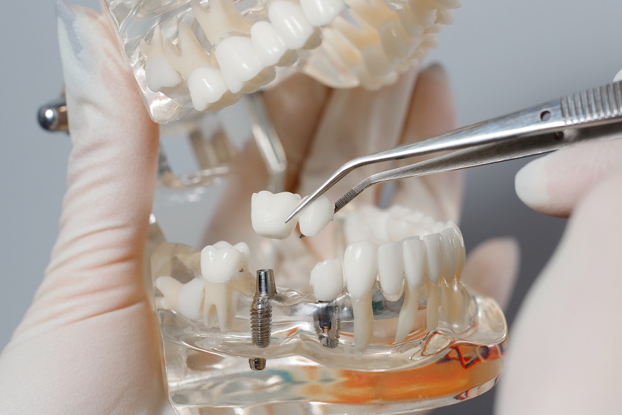 Understanding The Various Factors That Contribute To Dental Implants Cost